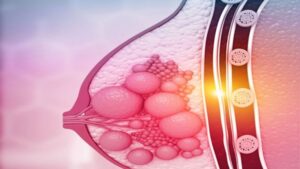 Meme Kanseri Tedavisi