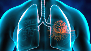 Akciğer, Cilt Kanserleri, Malign melanom, Squamöcil, Over, Endometerium ve Serviks Tedavisi