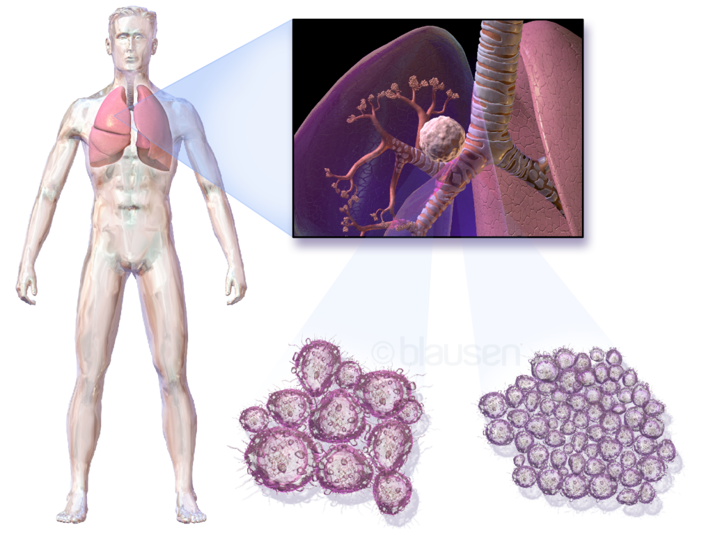 Medical illustration showing a tumour mass inside the lung