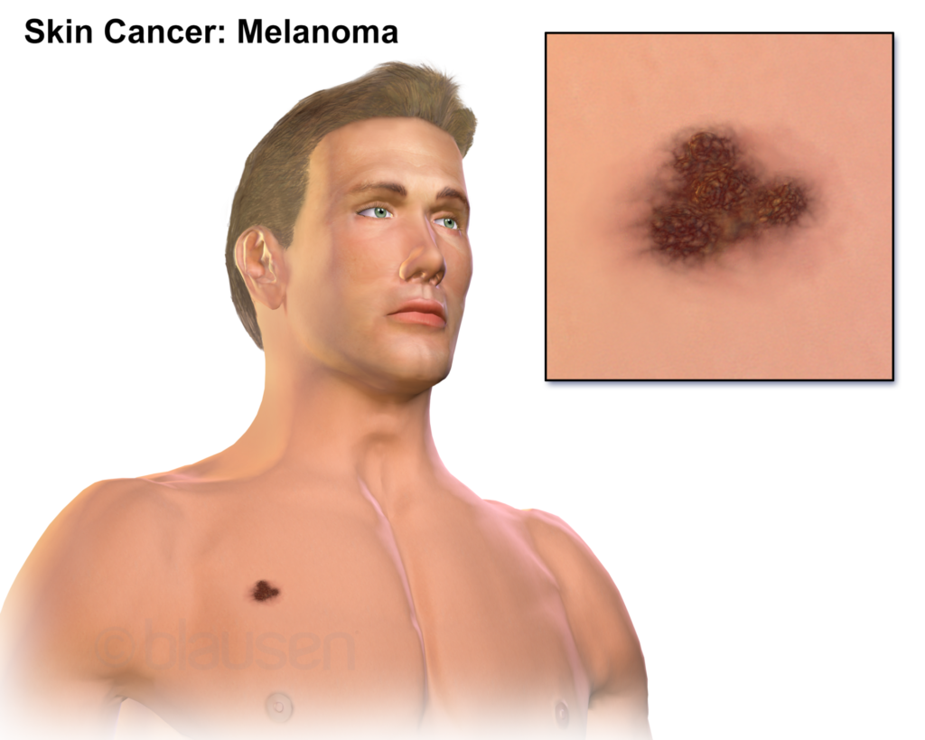 Medical illustration of melanoma spreading through the skin layers