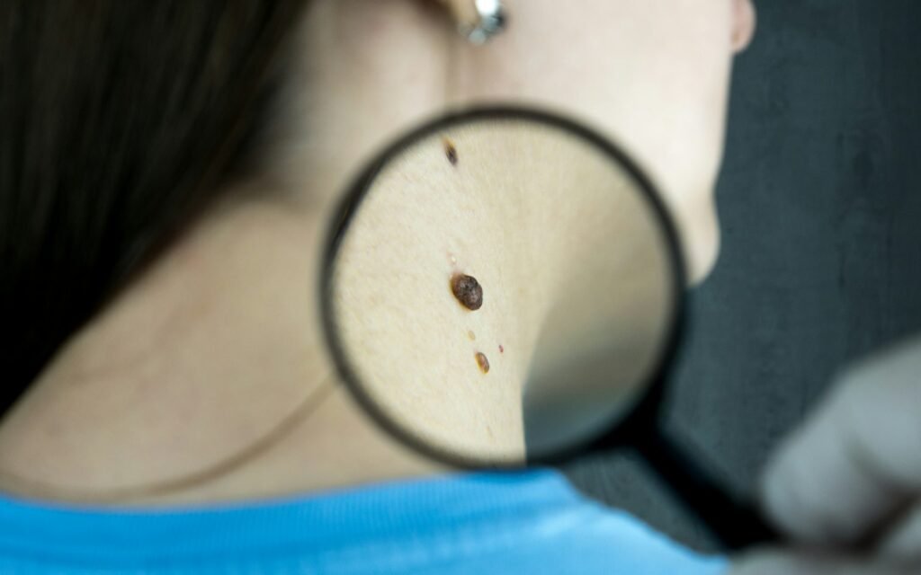 Dermatoskopla cilt incelemesi