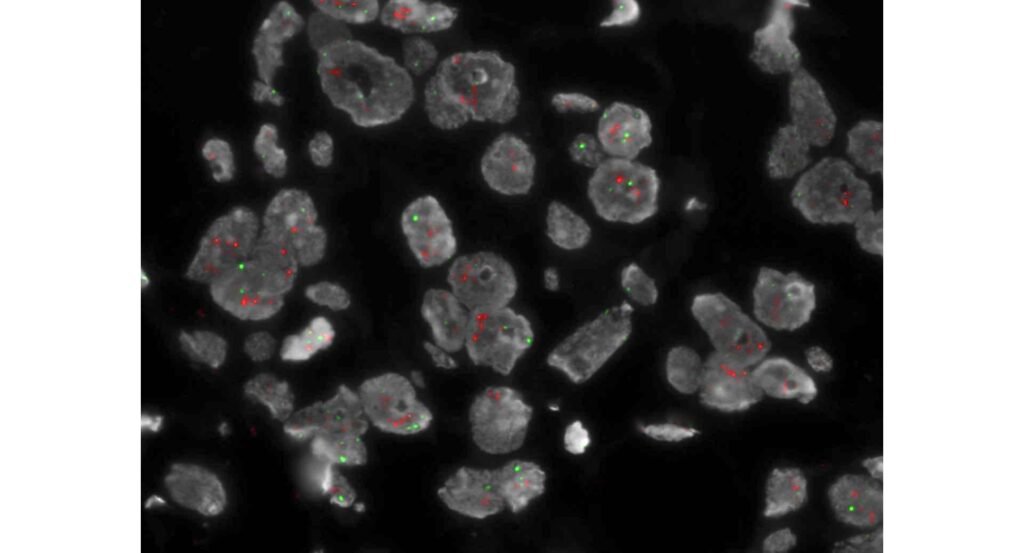 HER2 gen amplifikasyonunu gösteren floresan in situ hibridizasyon mikroskop görüntüsü
