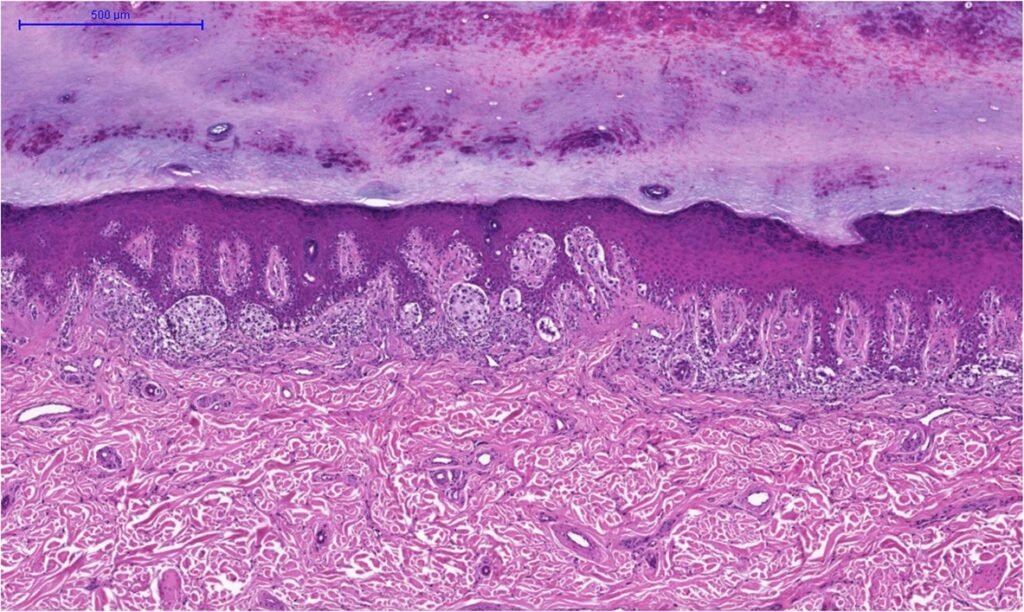 Low-magnification histopathology image of an acral lentiginous melanoma tissue section