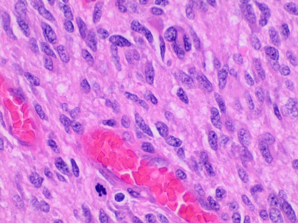 High-magnification light microscope histopathology image of a glioblastoma tissue section