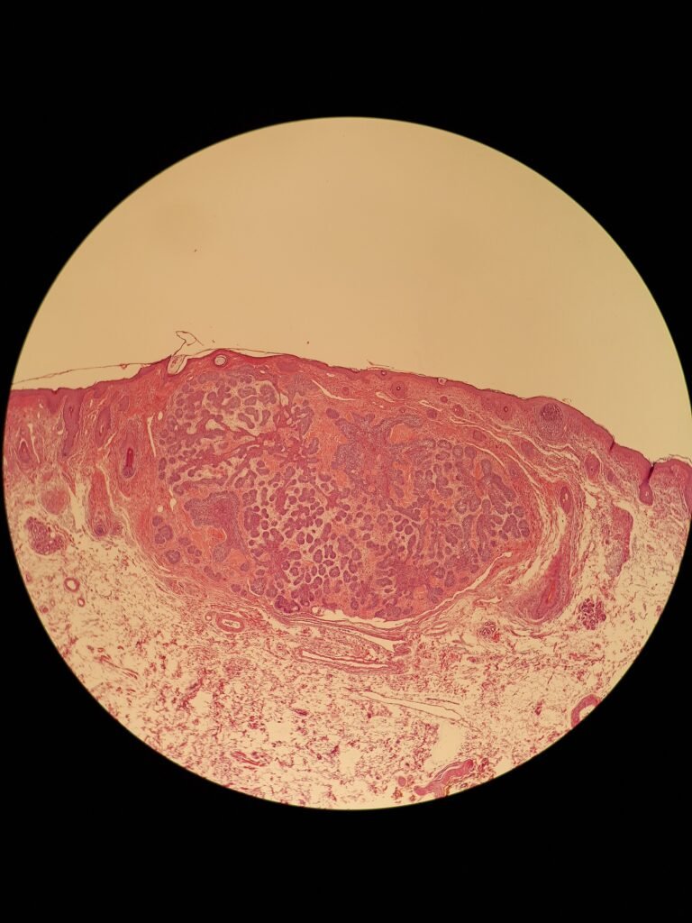 Light microscope image of a micronodular basal cell carcinoma tissue section