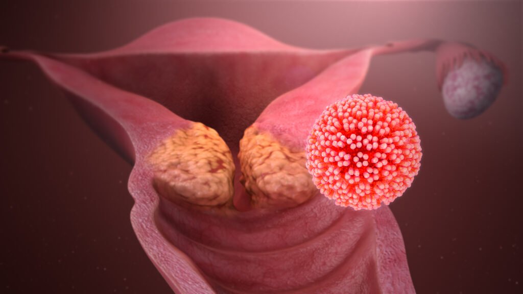 HPV enfeksiyonunun rahim ağzı hücrelerinde kansere yol açışını gösteren illüstrasyon