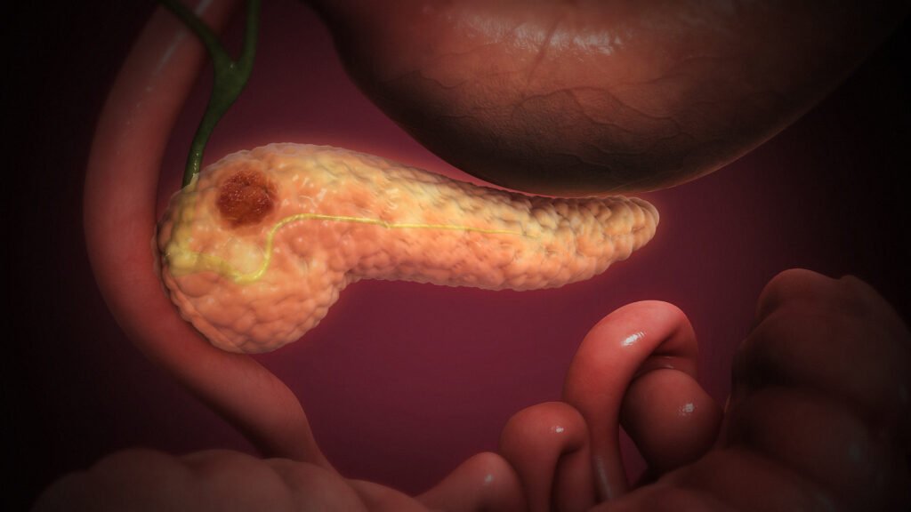 Pankreas dokusunda kitle oluşturan kanser hücrelerini gösteren üç boyutlu illüstrasyon