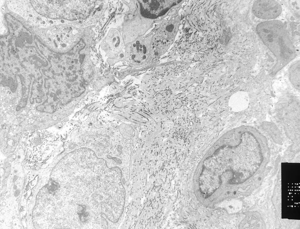 Electron microscope image of soft tissue sarcoma cells